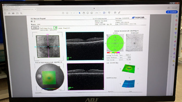 oct topcon 3d 2000 3d macula
