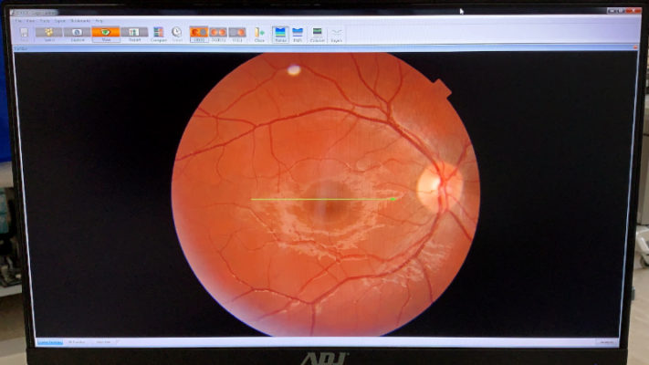 oct topcon 3d 2000 fundus