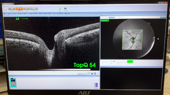 oct topcon 3d 2000 nervo ottico