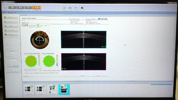 oct topcon 3d 2000 pachimetria segmento anteriore