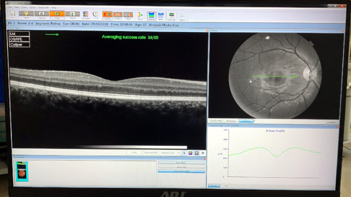 oct topcon 3d 2000 retina